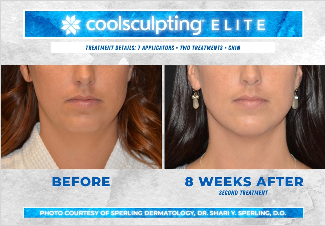 CoolSculpting Elite Chin Fat Package (save €351)