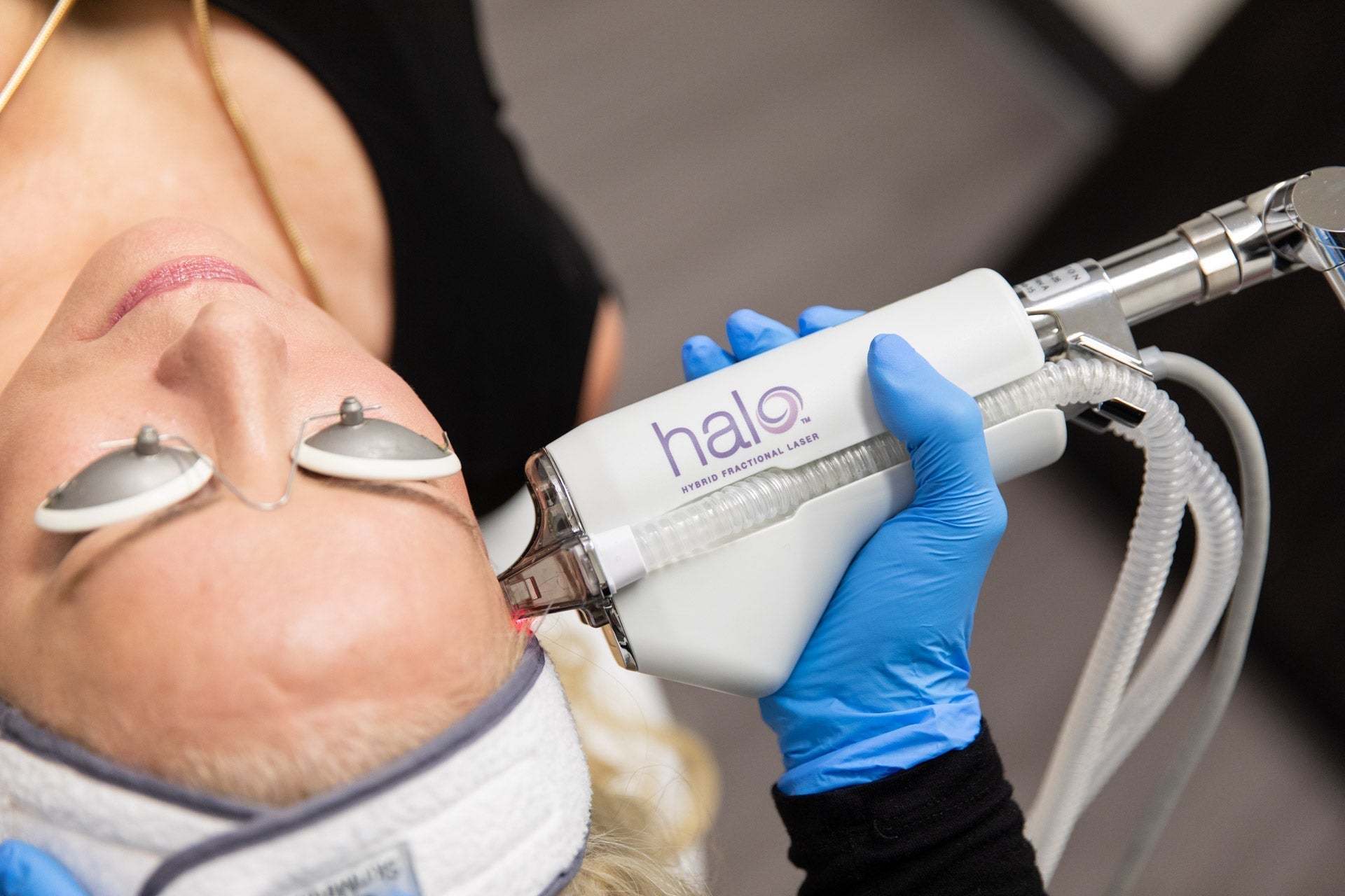 Summer Stax Laser Duo: BBL + HALO Skin Rejuvenation (save up to €601)