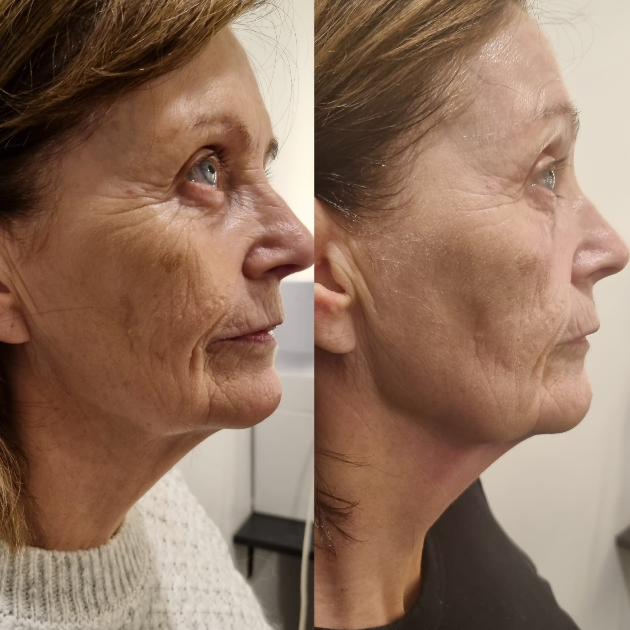 Thermage FLX 1 Week Post One Treatment