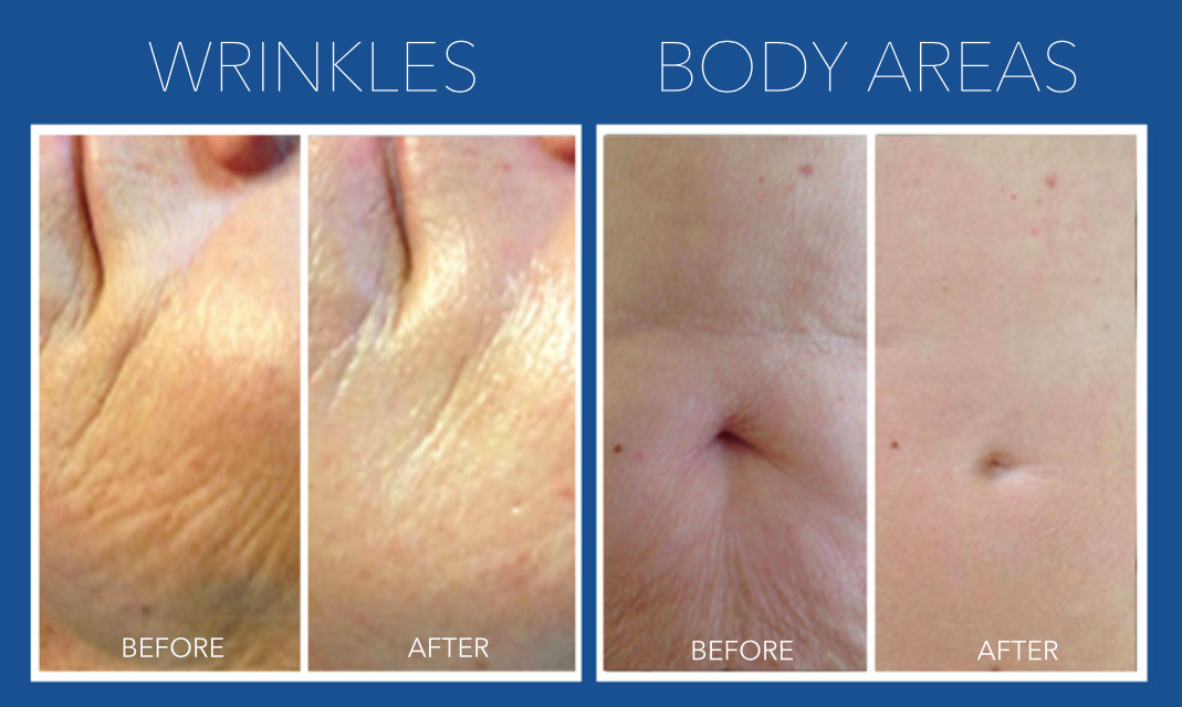 Dermapen Deluxe Microneedling with Uber Peel & LED Course of 2 (save €251)