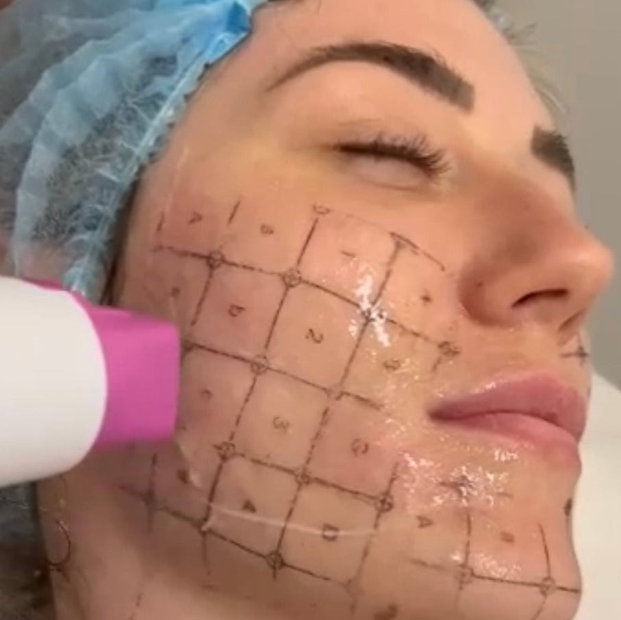 Thermage FLX RF Anti-Ageing Skin Tightening Treatment (save up to €601)