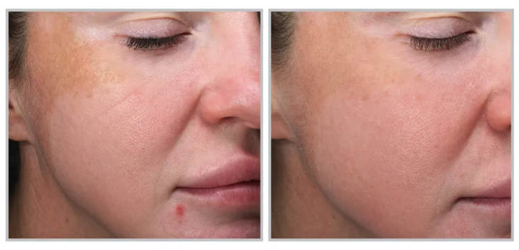 MOXI Laser Skin Rejuvenation Single Session (save €101)