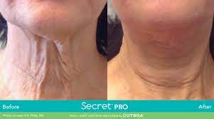 CO2 Ablative Laser Resurfacing save up to €701