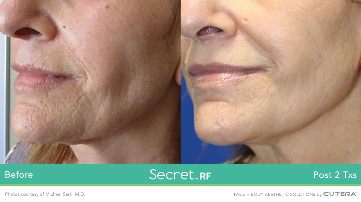 CO2 Ablative Laser Resurfacing save up to €701