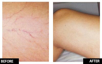 Laser thread vein reduction for small area course of 4 (save €301)