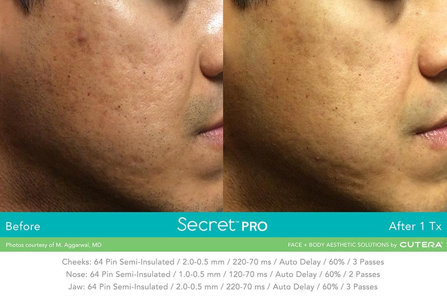 Cutera Secret RF +Microneedling Course of 3 with optional Exosomes (save up to €1,001)