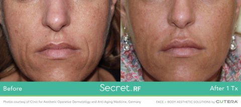 Secret RF +Microneedling & CO2 Laser Duo with Exosomes (save up to €701)