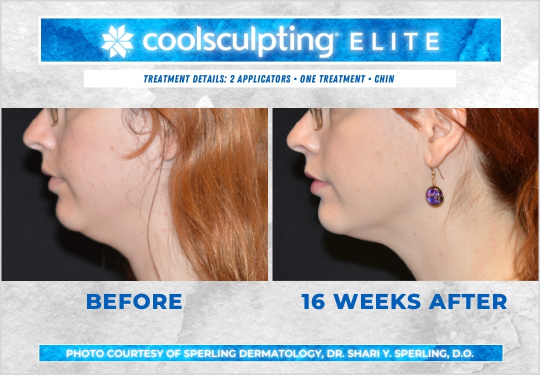 CoolSculpting Elite Chin Fat Package (save €351)