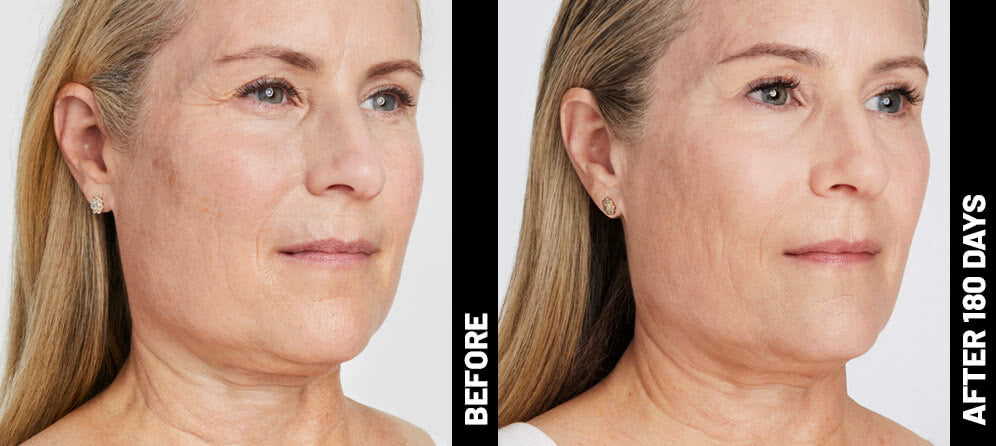 Ultherapy Non-Surgical Face Lift Package for lower face and jawline (save €301)