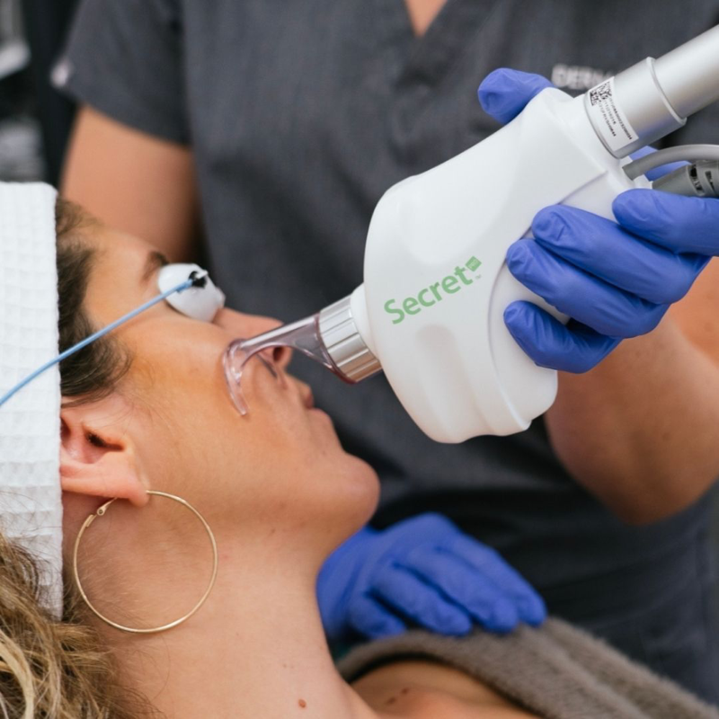 Utlimate Skin Rejuvenation: Secret RF Microneedling +CO2 Laser +Exosomes (save up to €1,201)