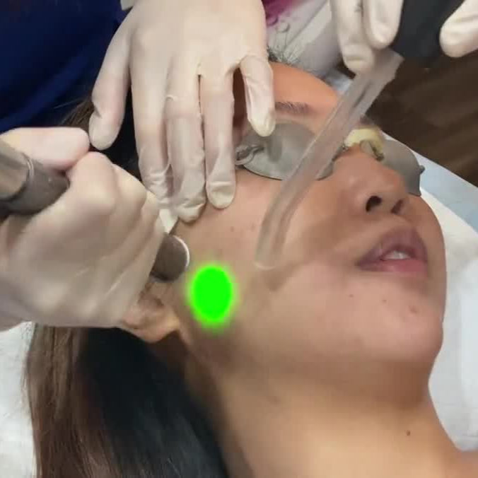 Laser Lite Facial for ageing, pigmentation or redness (save up to €451)