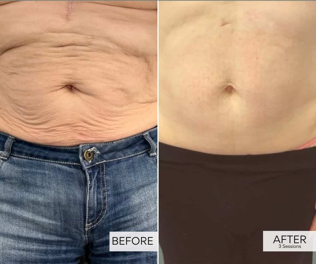Morpheus8 Deep RF Microneedling for Body Area course of 3 (save up to €551)