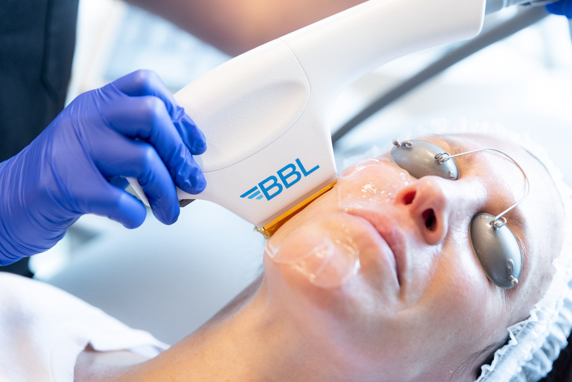 MOXI Laser + BBL Skin Rejuvenation
