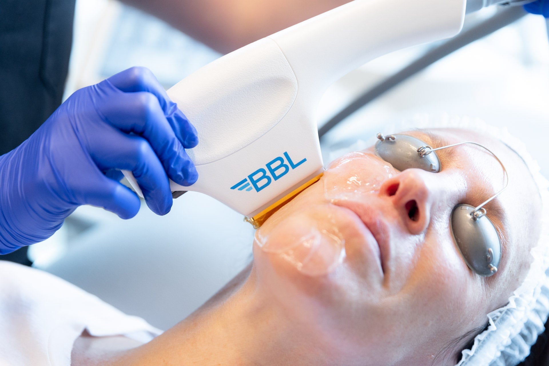 BBL Laser + Microneedling for Face & Neck Course of 3 (save €451)