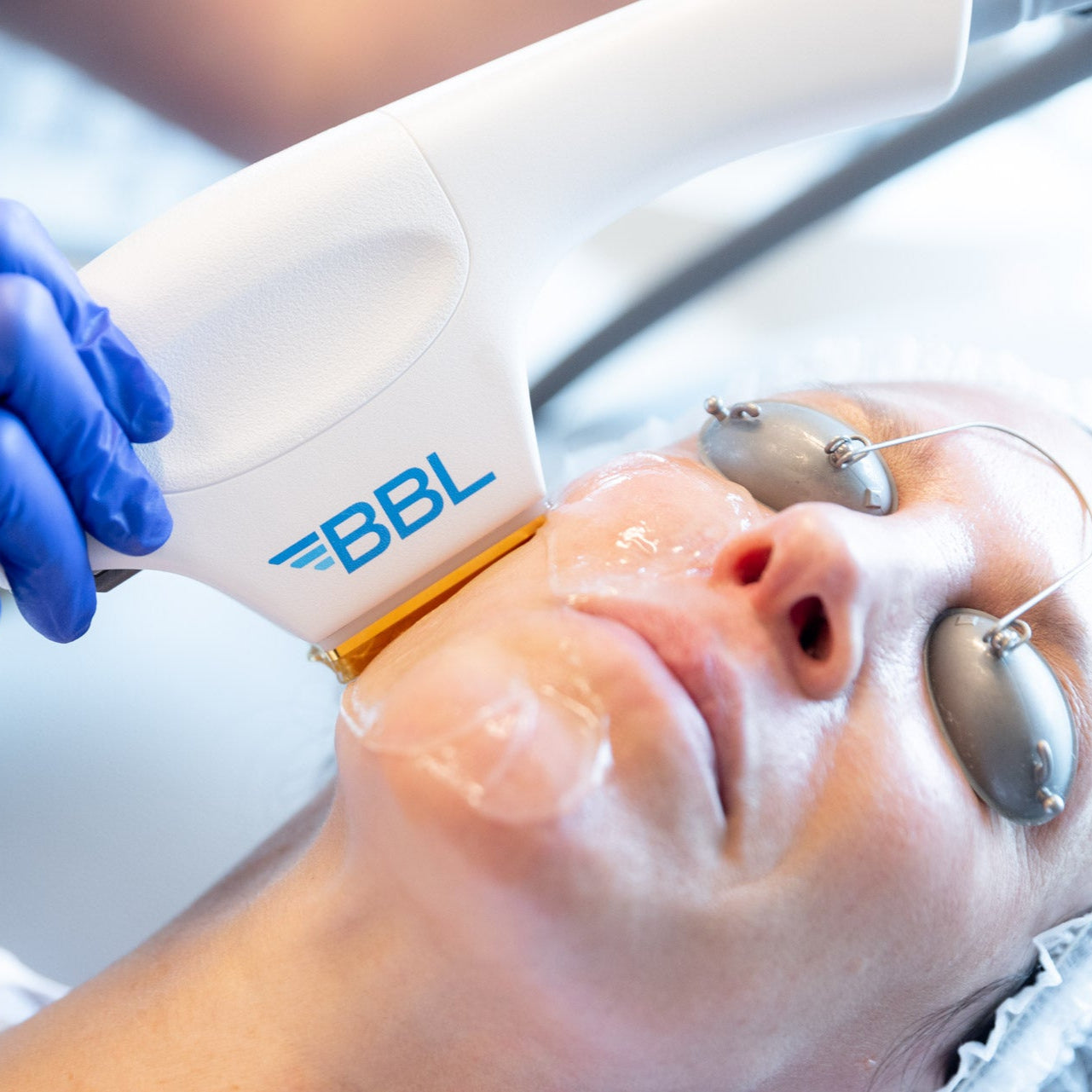 SWC 5-Step Advanced Facial: HydraFacial, BBL Laser, Microneedling, Peel, & LED (save €351)