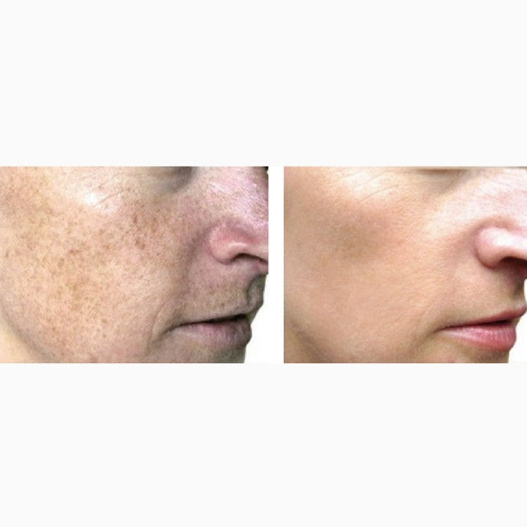 BBL Laser Skin Rejuvenation Course of 3 (save up to €301)