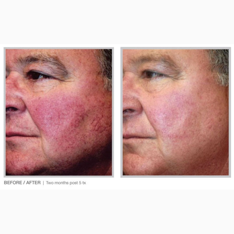 BBL Laser Skin Rejuvenation Course of 3 (save up to €301)