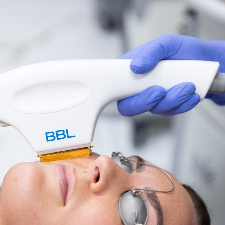 BBL Laser Skin Rejuvenation Course of 3 (save up to €301)