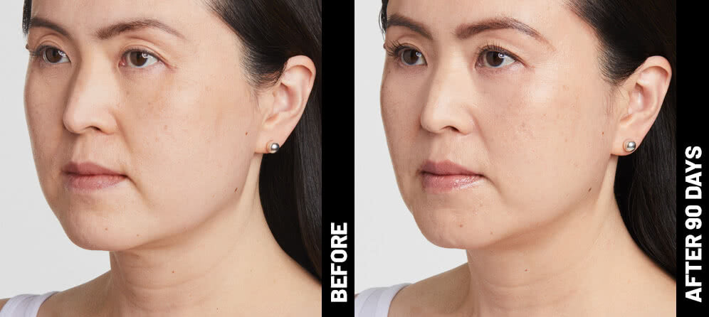 Ultherapy Non-Surgical Face Lift Package for lower face and jawline (save €301)