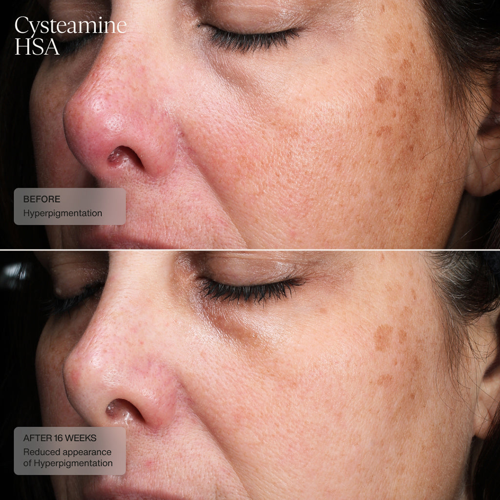 Sente Pigment & Tone Correcting Mask, Cysteamine + HSA