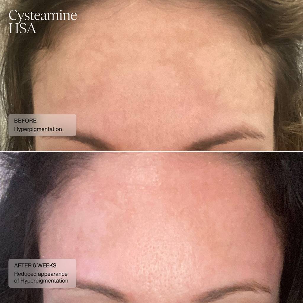 Sente Pigment & Tone Correcting Mask, Cysteamine + HSA