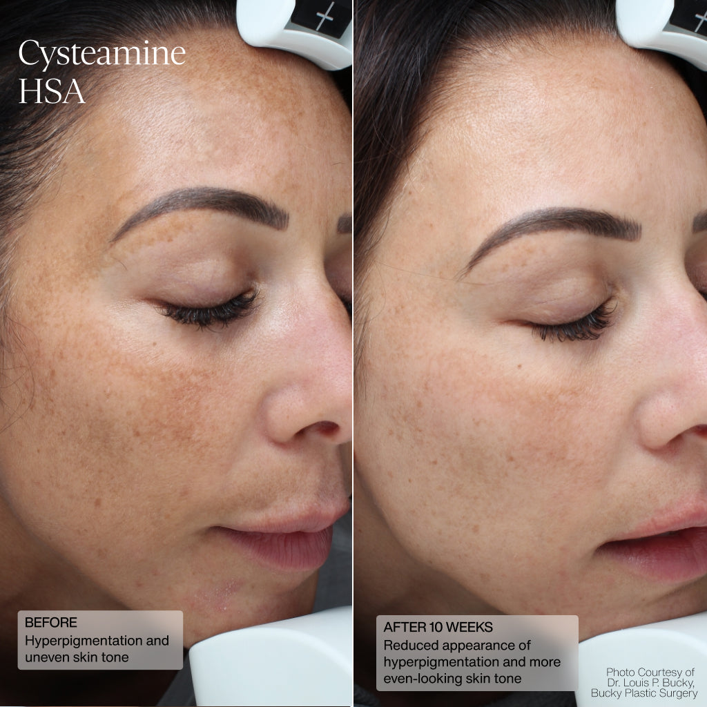 Sente Pigment & Tone Correcting Mask, Cysteamine + HSA