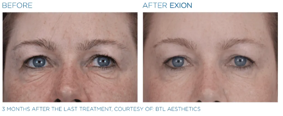 EXION RF +Microneedling Treatment