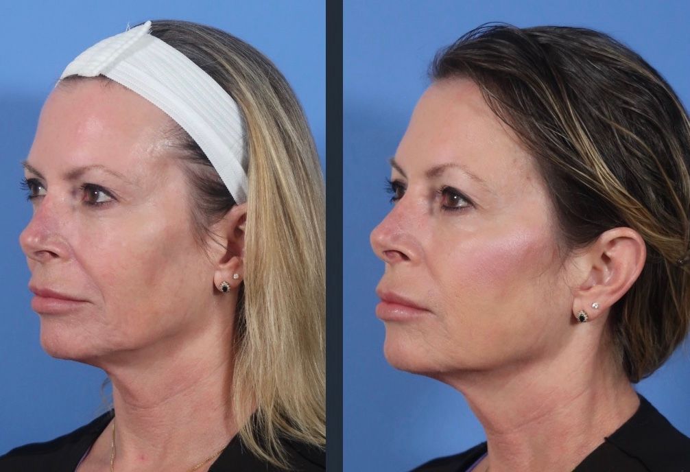 NEW FaceTite by InMode Fat Reduction & Skin Tightening +FREE Morpheus8 RF Microneedling (save €1,401)