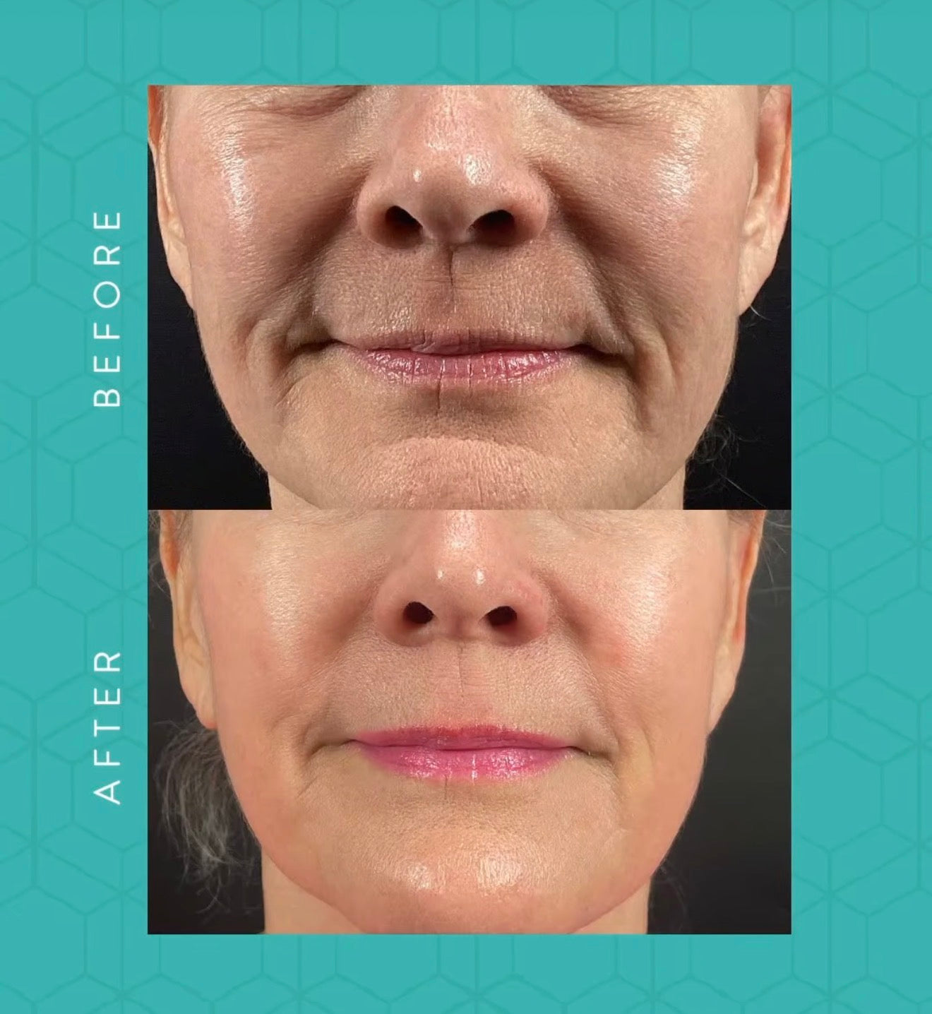 Morpheus8 RF Microneedling Course of 3 with optional Exosomes (save up to €551)