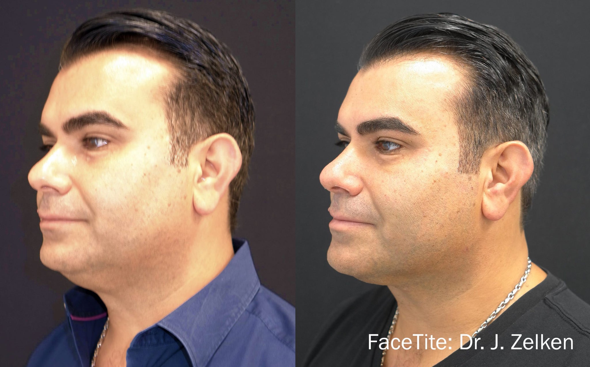 NEW FaceTite by InMode Fat Reduction & Skin Tightening +FREE Morpheus8 RF Microneedling (save €1,401)