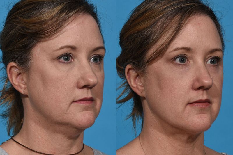 NEW FaceTite by InMode Fat Reduction & Skin Tightening +FREE Morpheus8 RF Microneedling (save €1,401)