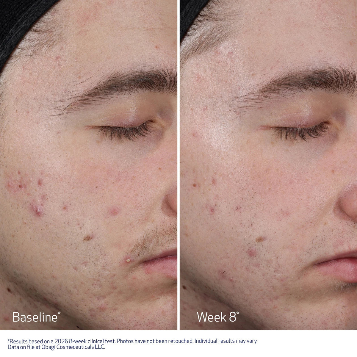 Obagi Medical CLENZIDERM M.D.® Resurfacing Multi-Acid Peel Pads (30 Pads)