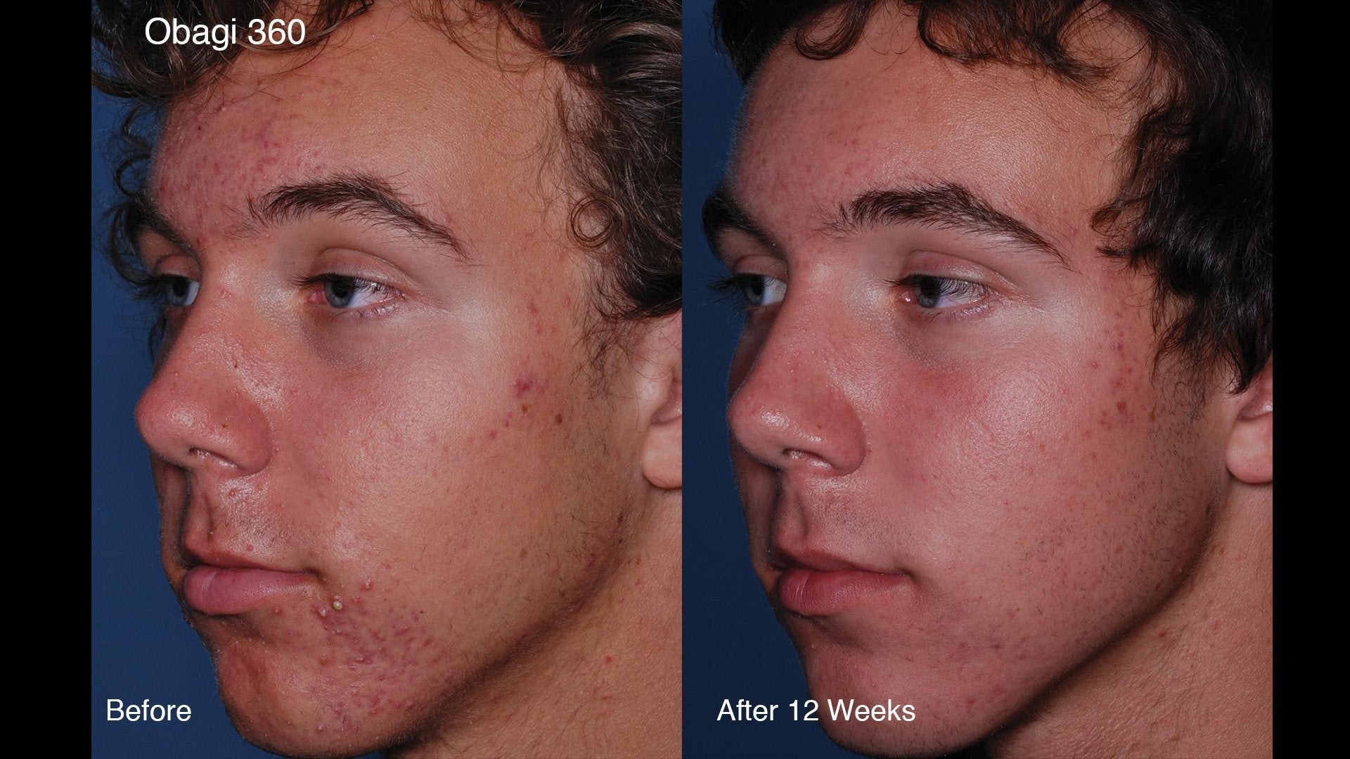 Obagi  CLENZIderm Daily Foaming Cleanser 118ml