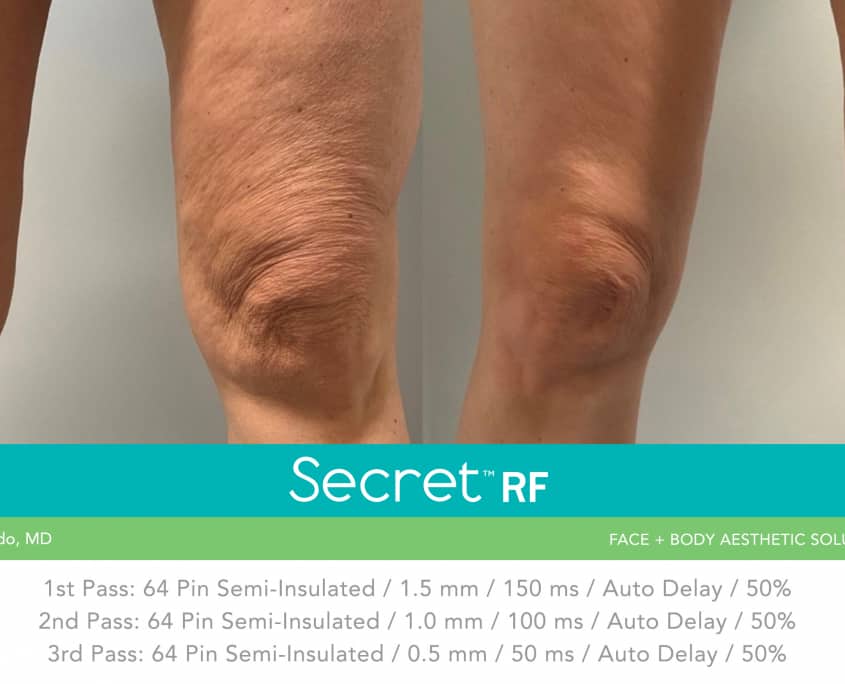 Secret RF +Microneedling Skin Rejuvenation & Tightening for Body Course of 4 (save up to €1,551)