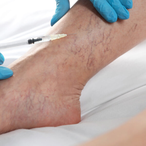 Sclerotherapy vein reduction injections course of 4 (save up to €601)