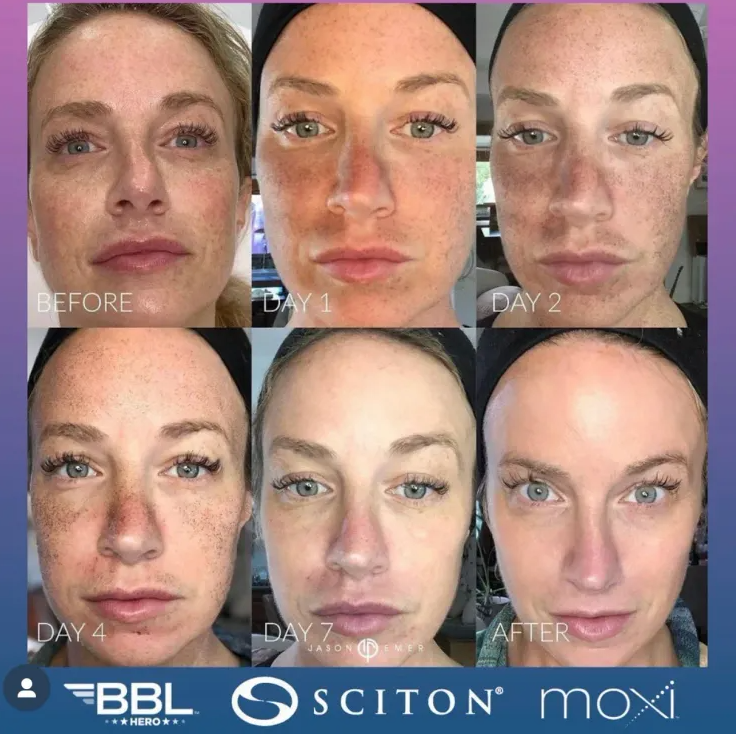 MOXI Laser + BBL Skin Rejuvenation