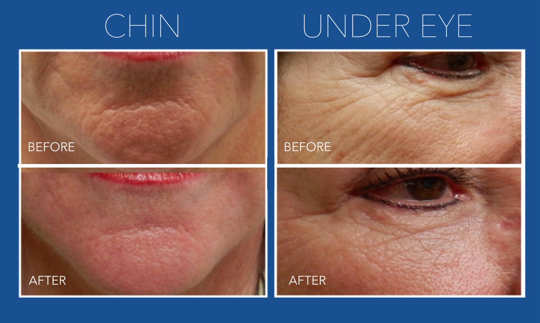 Dermapen Microneedling Course of 2 (save up to €201)
