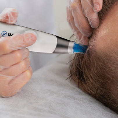 Microneedling with Exosomes Ultimate Scalp Package with Homecare Kit (save €386)