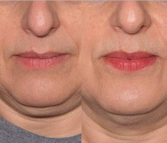 EmFace Non-Invasive Wrinkle and Lifting Treatment (save €201)