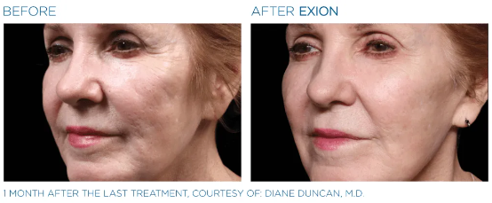 EXION RF +Microneedling Treatment