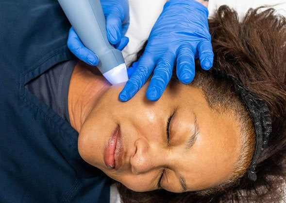 EXION RF +Microneedling Treatment