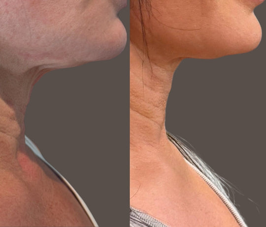 Purasomes Exosome Treatment for Face or Scalp (save €101)