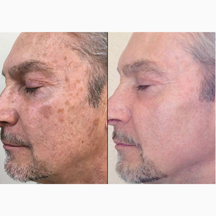 HALO Laser Skin Resurfacing (save €401)
