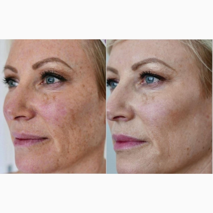 HALO Laser Skin Resurfacing (save €401)