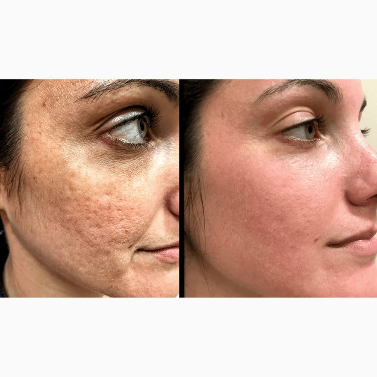 HALO Laser Skin Resurfacing (save €401)