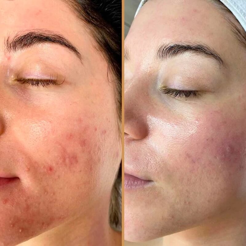 Platinum 6-Step HydraFacial 50-Mins with Skin Booster Course of 4 (save up to €411)