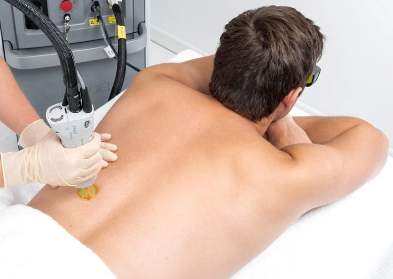 Laser Hair Removal for Men Full Back & Shoulders course of 4 (save €177)