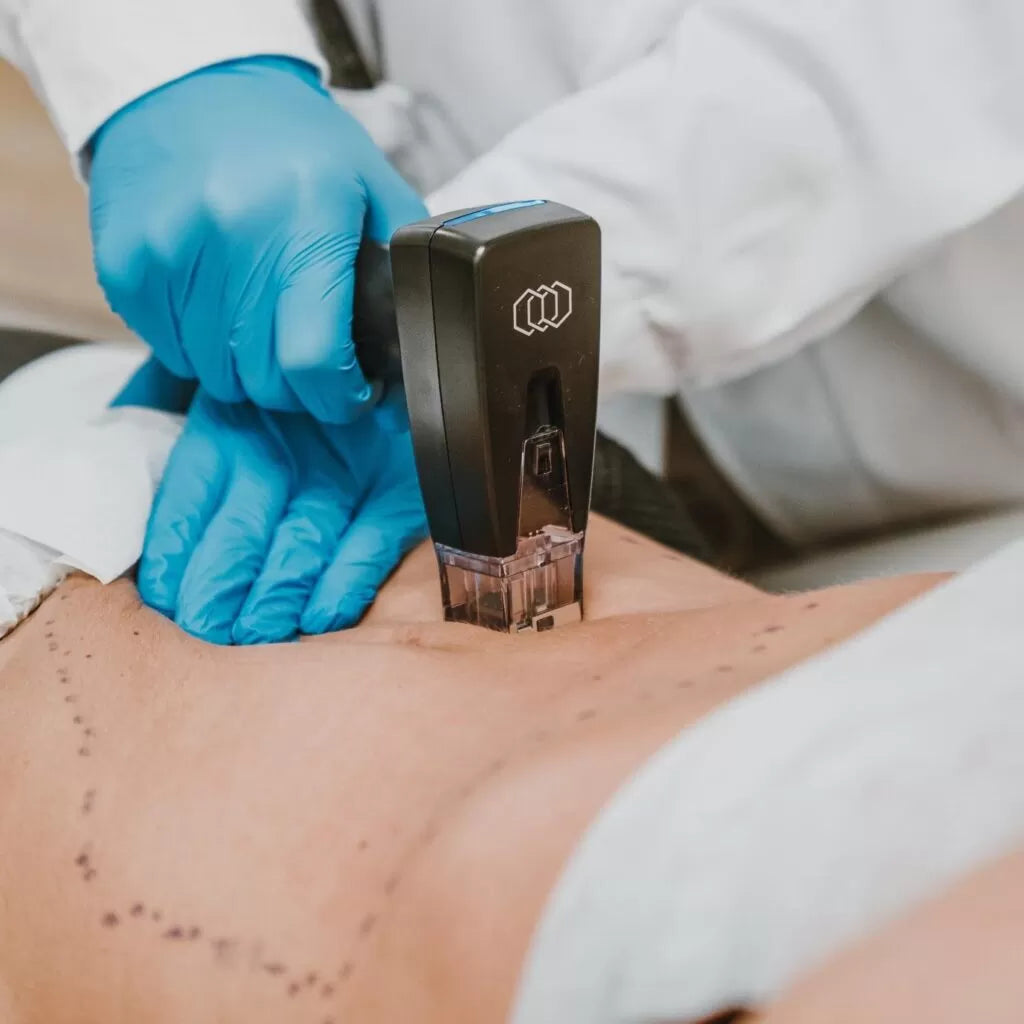 Morpheus8 Deep RF Microneedling for Body Area course of 3 (save up to €551)