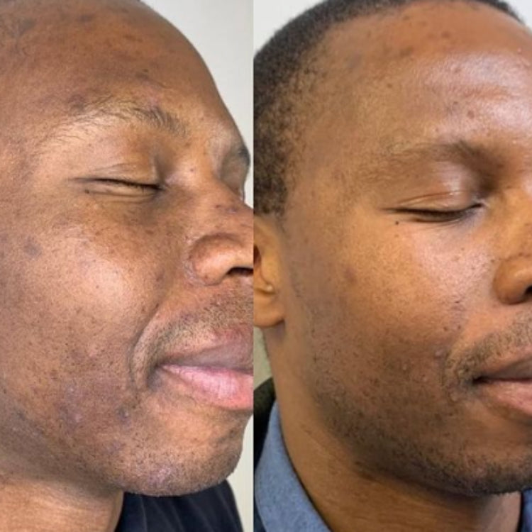 MOXI Laser Skin Rejuvenation course of 2 (save up to €801)