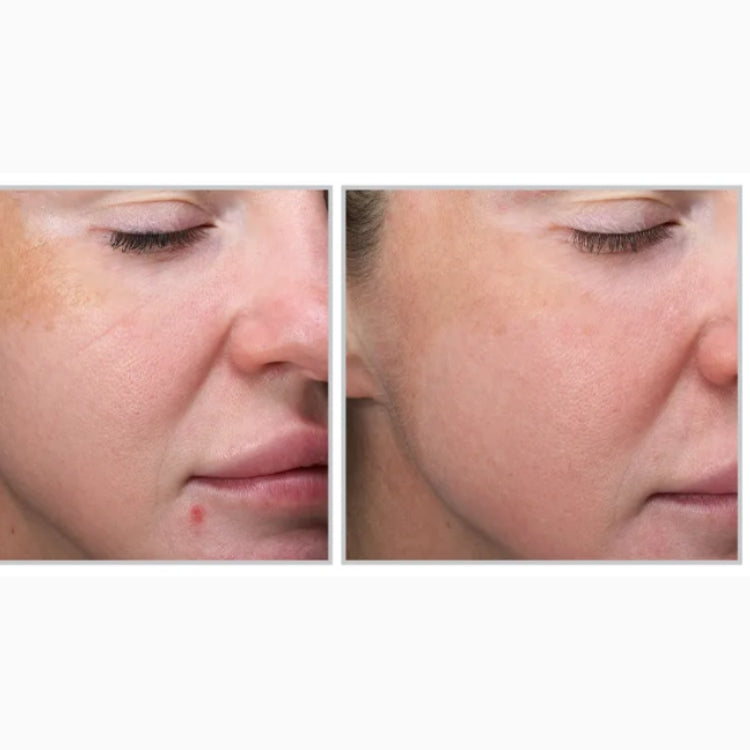 MOXI Laser Skin Rejuvenation course of 2 (save up to €801)